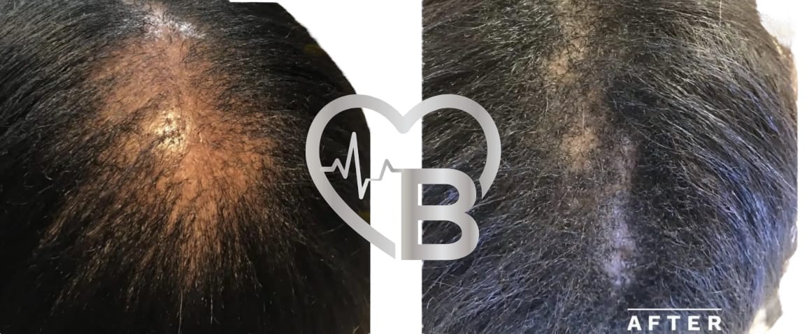 Hair Follicle Stimulator