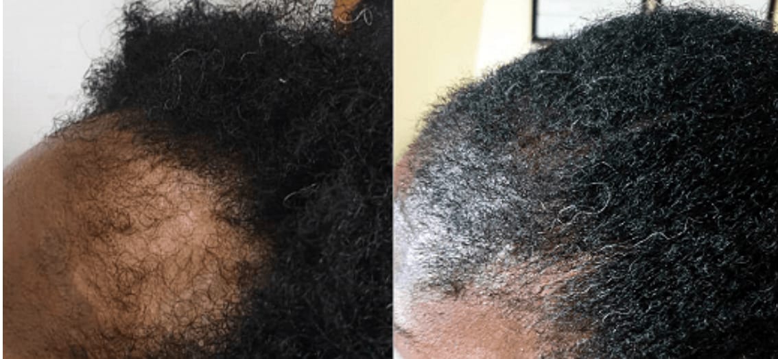 Hair Follicle Stimulator